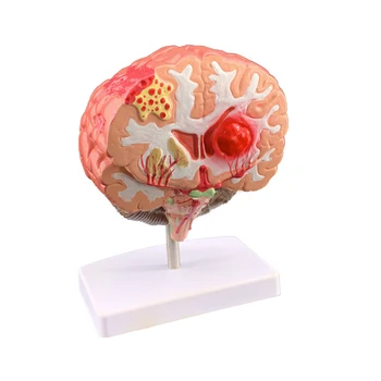 Simulação do cérebro humano modelo de doença cérebro anatomia neurocirurgia cérebro patologia cerebral patologia anatômica modelo médico